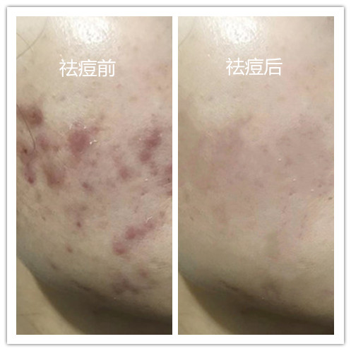 祛痘前后對比