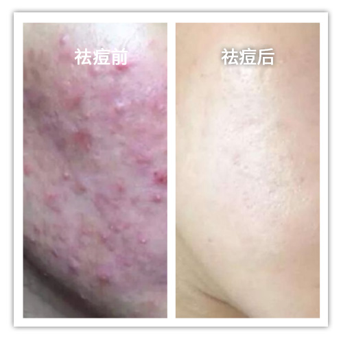 祛痘前后對比